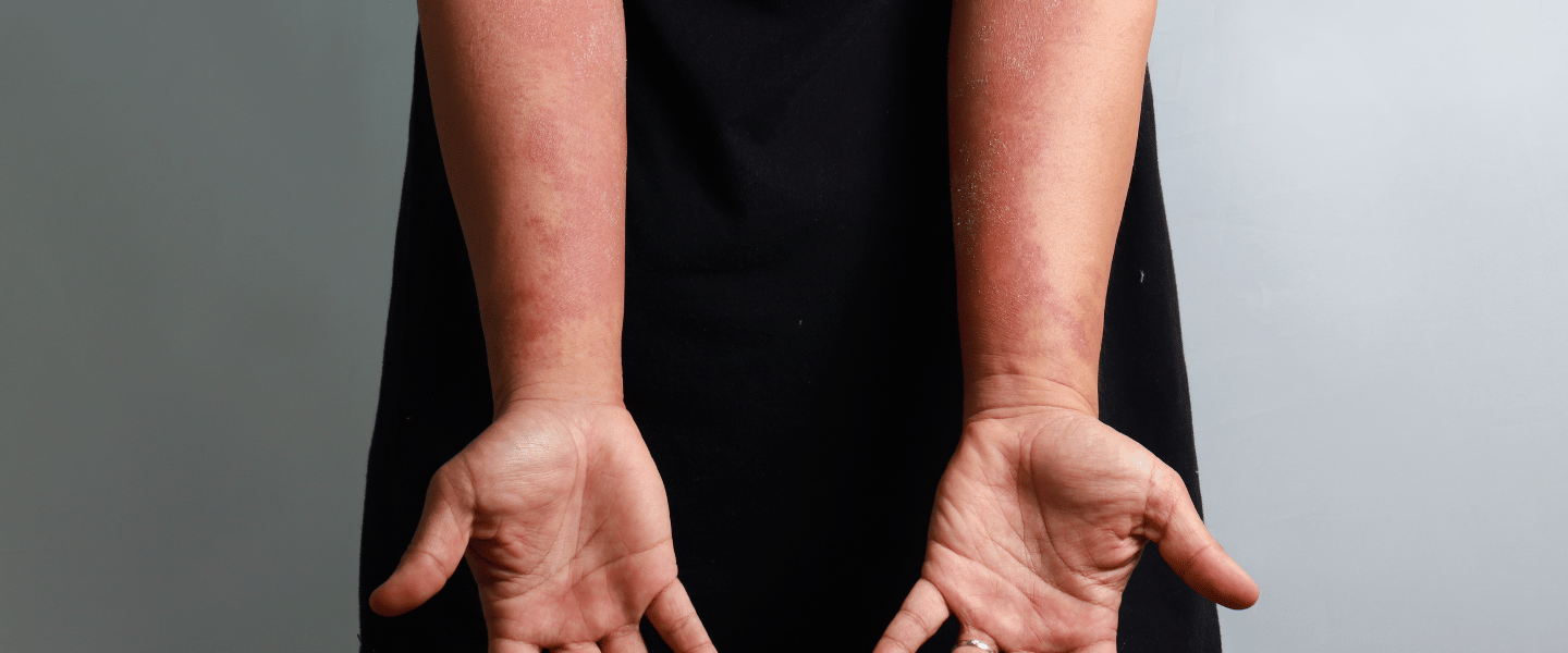 The Secret to Eczema Relief: Discover the Gentle Care of Laurel and Olive Oil Soap